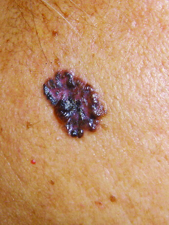 A basal cell carcinoma may be pigmented, like this one, on skin of color.