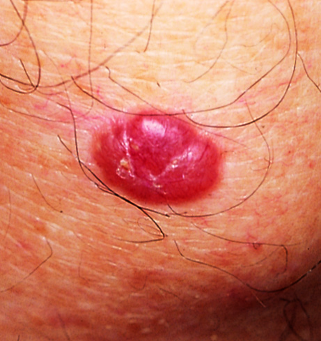 Basal cell carcinoma copy