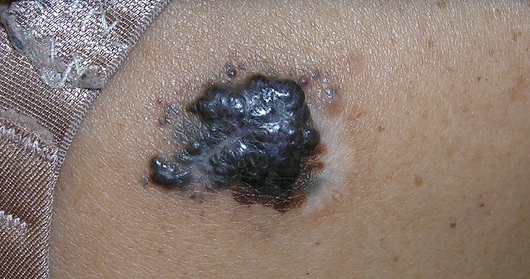 Dark, raised melanoma