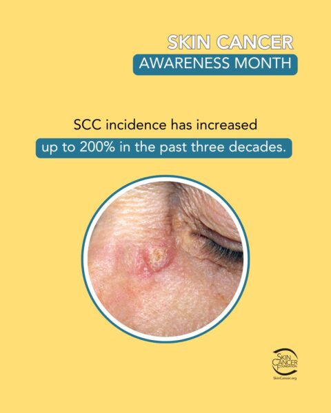 skin-cancer-awareness-month.jpg Skin cancer awareness month poster with a photo of skin cancer on the face.