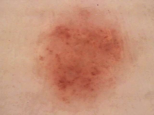 Actinic keratosis