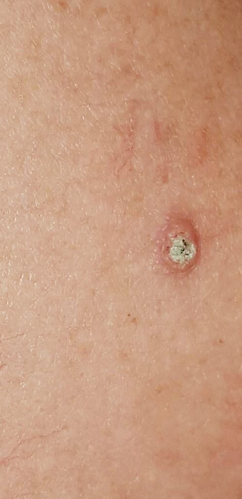 Actinic keratosis on posterior torso