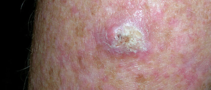 Large, crusty squamous cell carcinoma