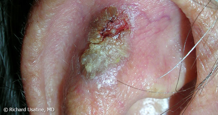 Large, crusty squamous cell carcinoma on ear
