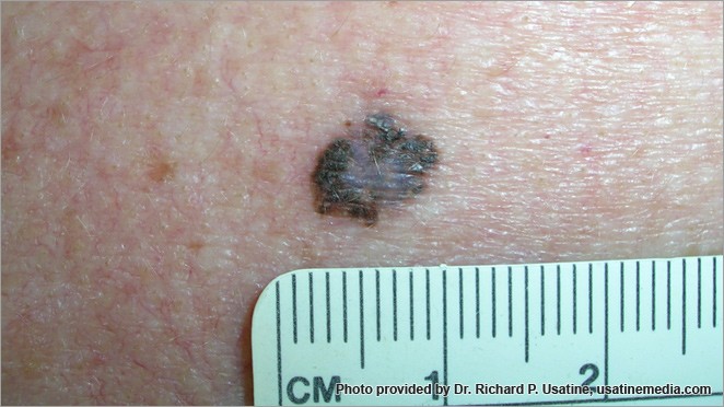 Large melanoma with irregular borders