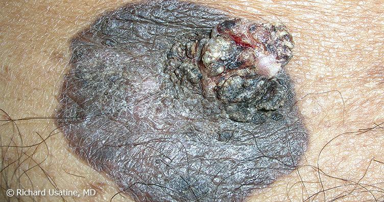 Large pigmented squamous cell carcinoma