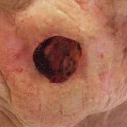 McCarthy-Mohs-2 large surgical wound after removing tumor on cheek