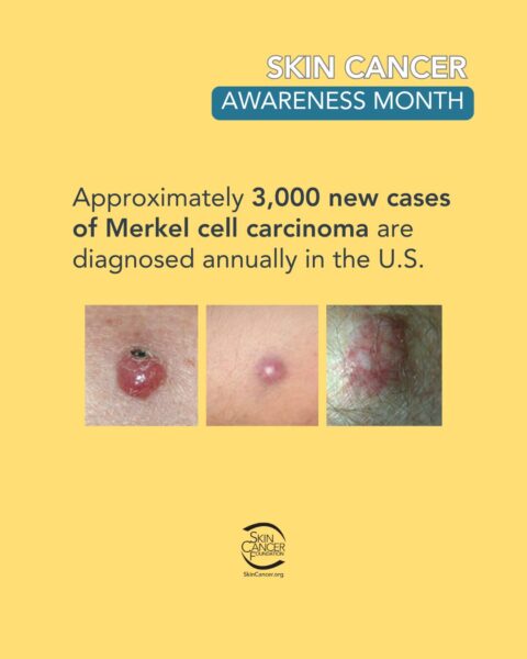 skin-cancer-awareness-month-merkel-cell-carcinoma A Skin Cancer Awareness Month poster with information and example images of Merkel cell carcinoma.