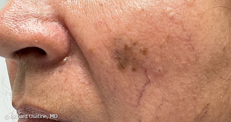 Melanoma on cheek