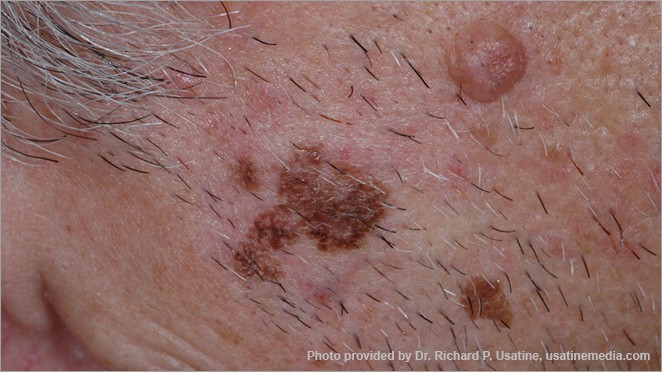 Melanoma with asymmetry and irregular borders