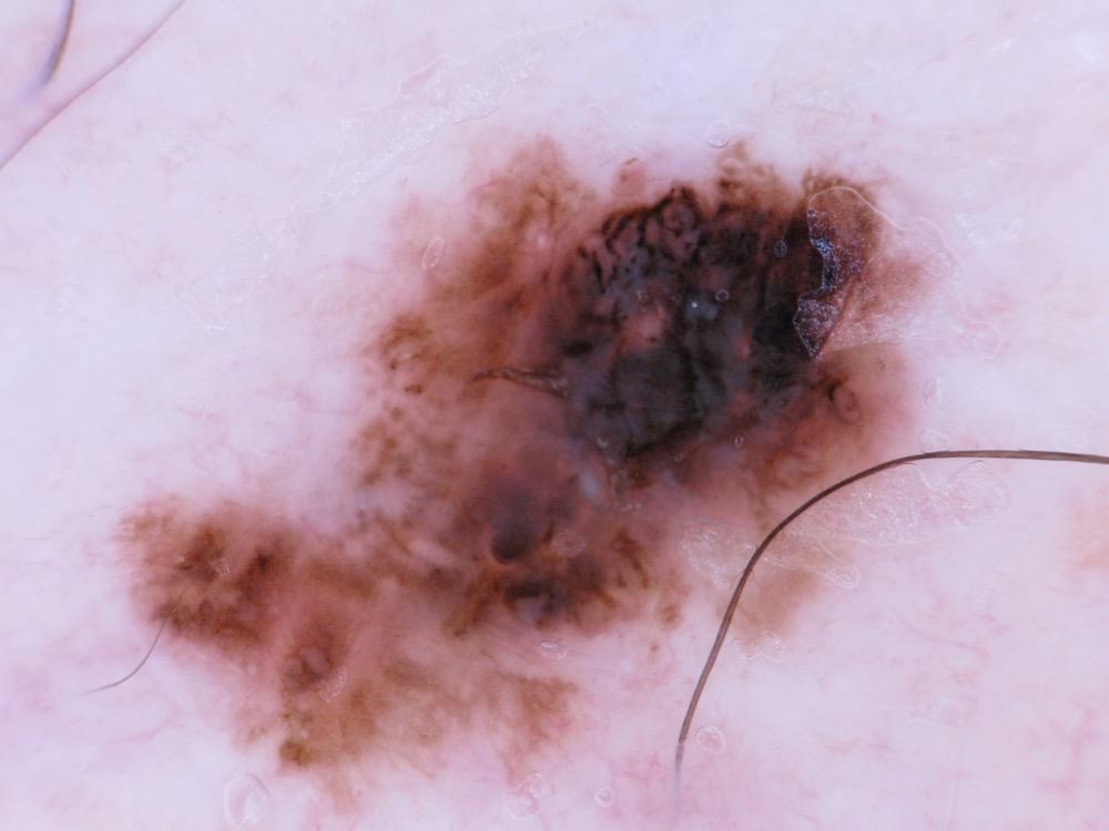 Melanoma4