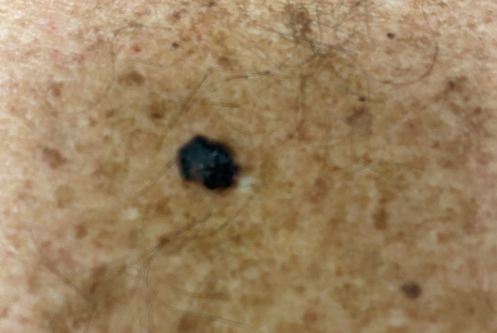 Nodular melanoma 1.3mm upper back courtesy EK Hale 1.25.22