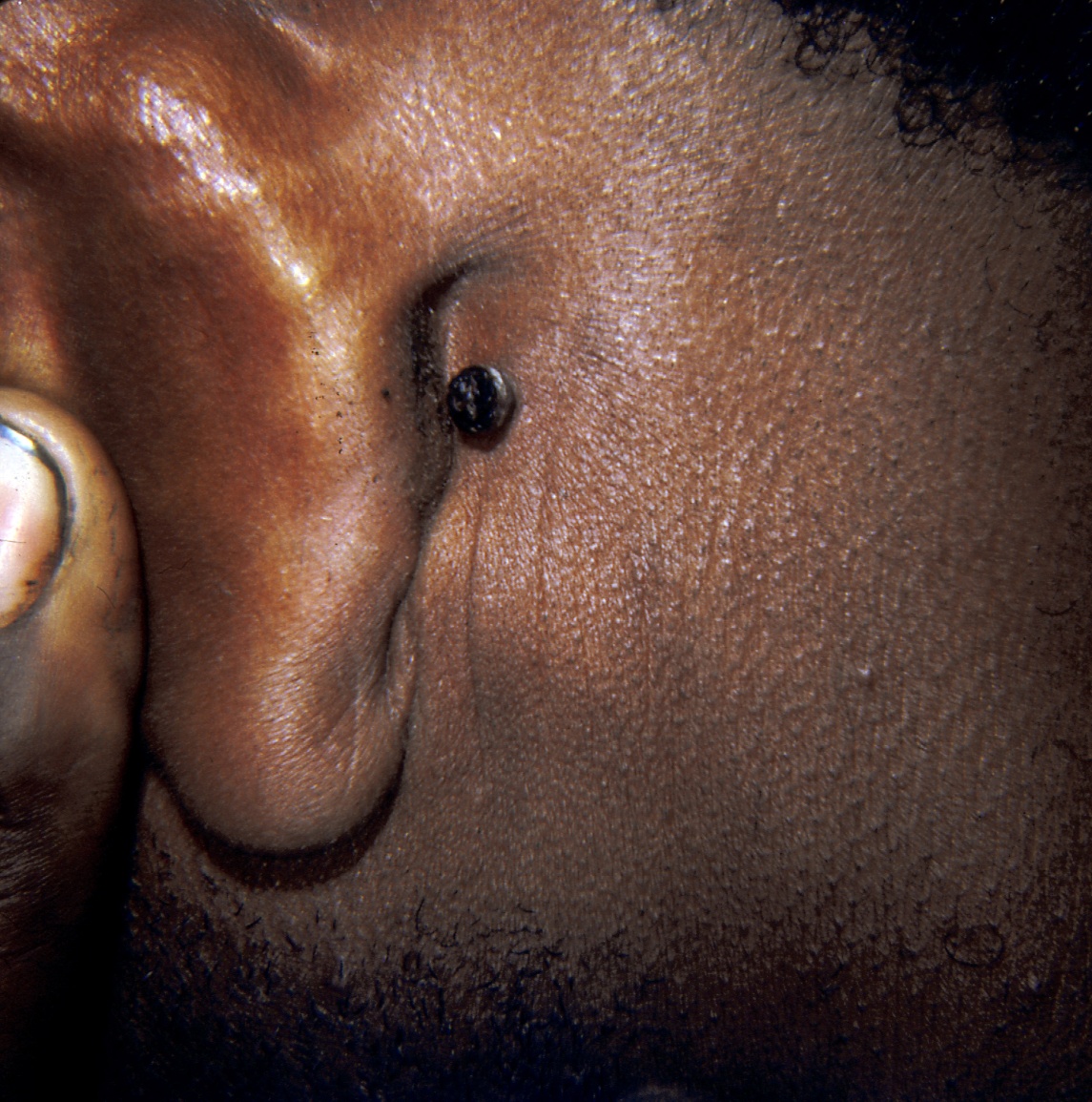 Pigmented BCC behind the ear