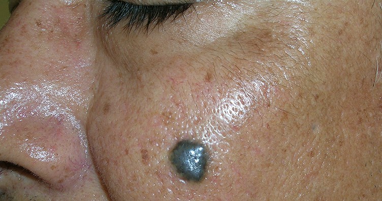 Pigmented basal cell carcinoma on cheek