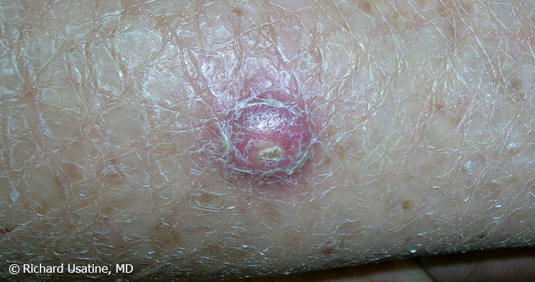 Raised, red, scaly squamous cell carcinoma