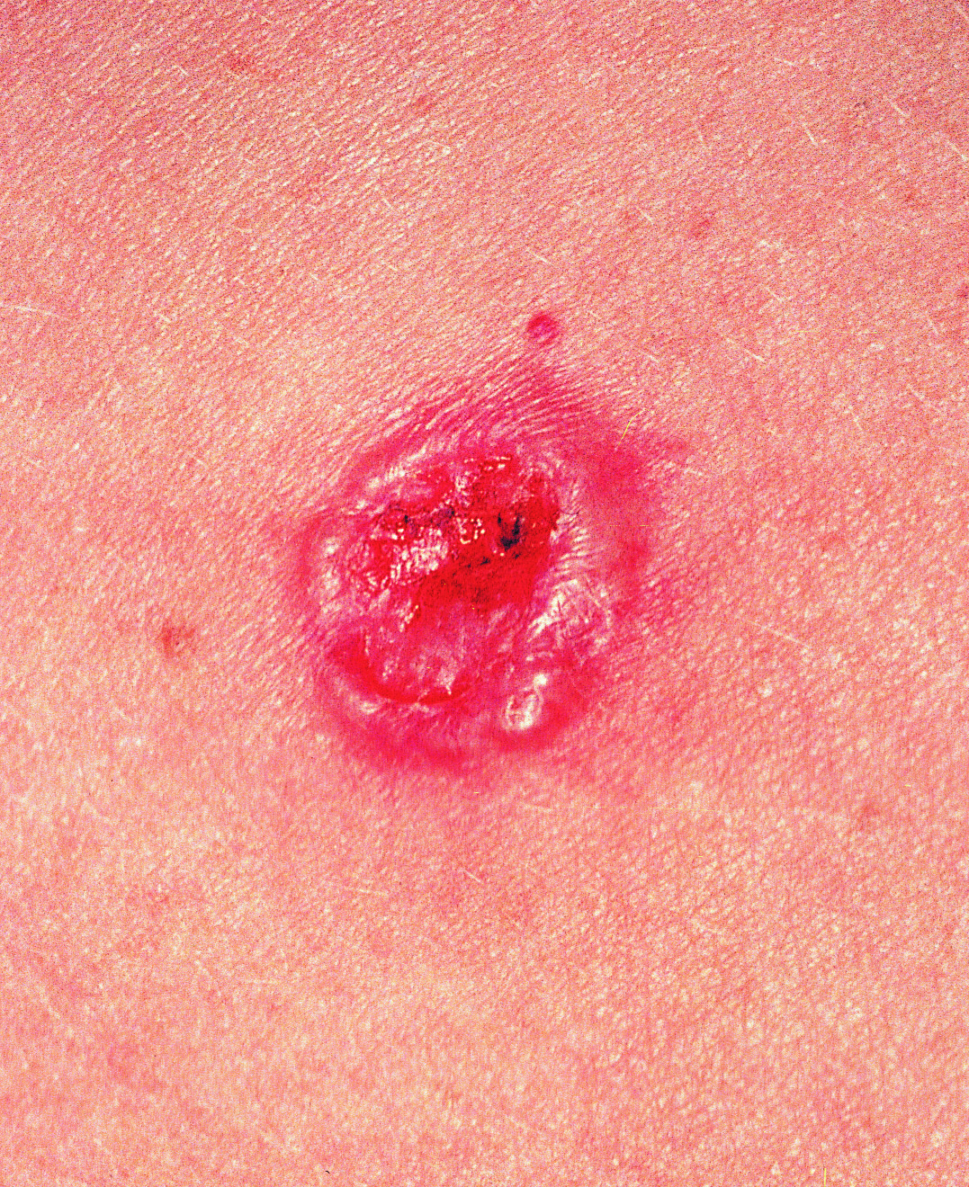 SCF_Basal cell carcinoma presenting as a pink growth