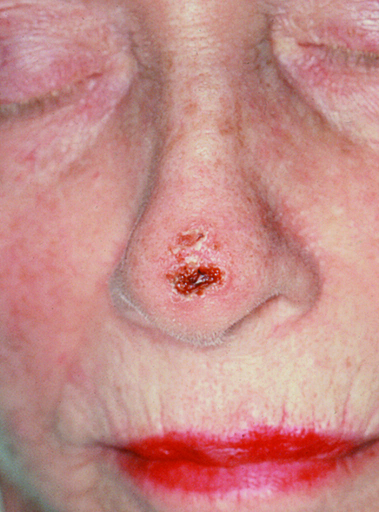 SCF_Squamous cell carcinoma on the nose