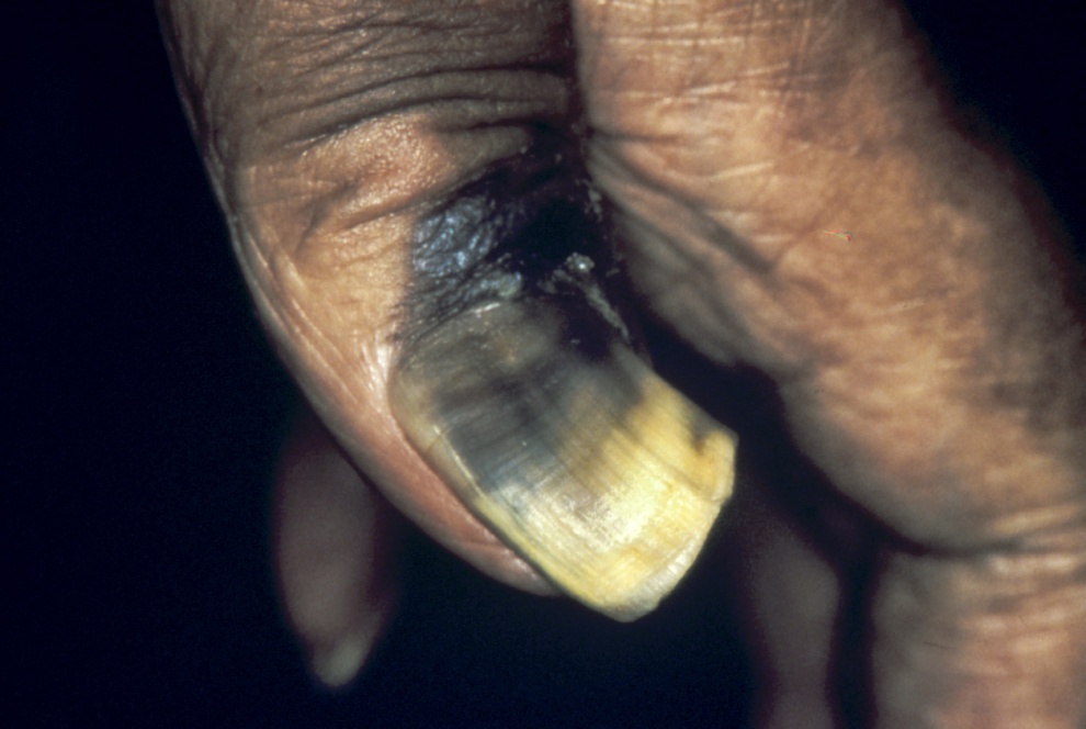 Slide 112 – Subungual melanoma Gloster