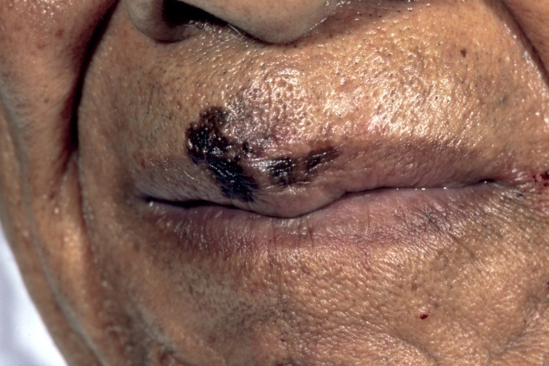 Slide 81 – Melanoma lip Black male Carl Washington MD
