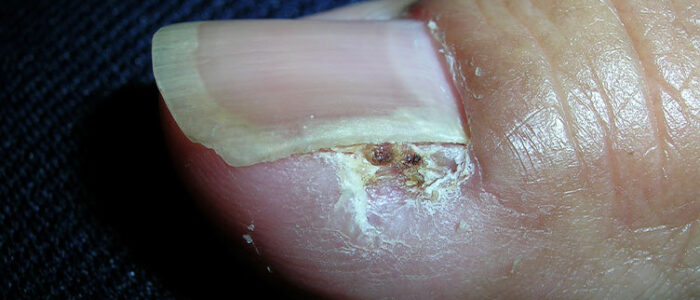 Squamous cell carcinoma beside toenail