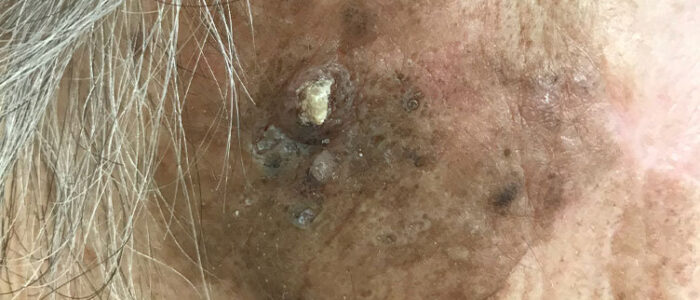 Squamous cell carcinoma near hairline
