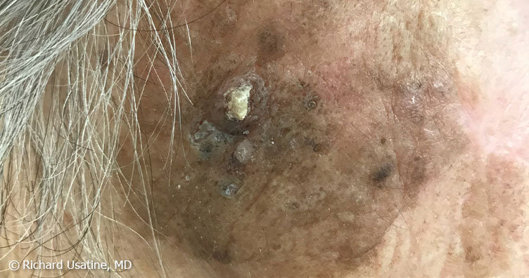 Squamous cell carcinoma near hairline