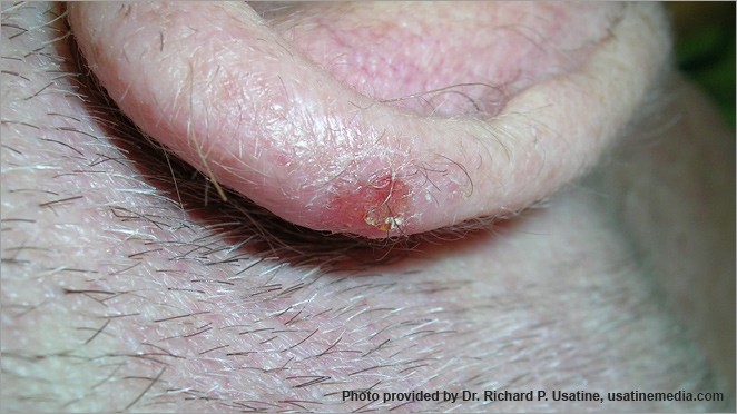Squamous cell carcinoma on ear