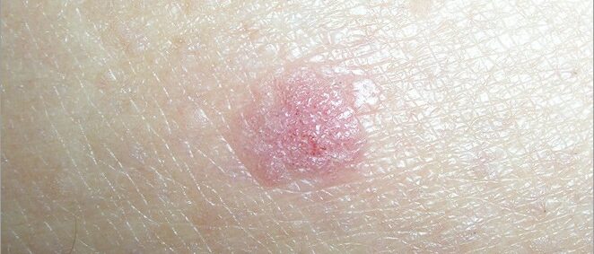 Squamous cell carcinoma on light skin Squamous cell carcinoma on light skin