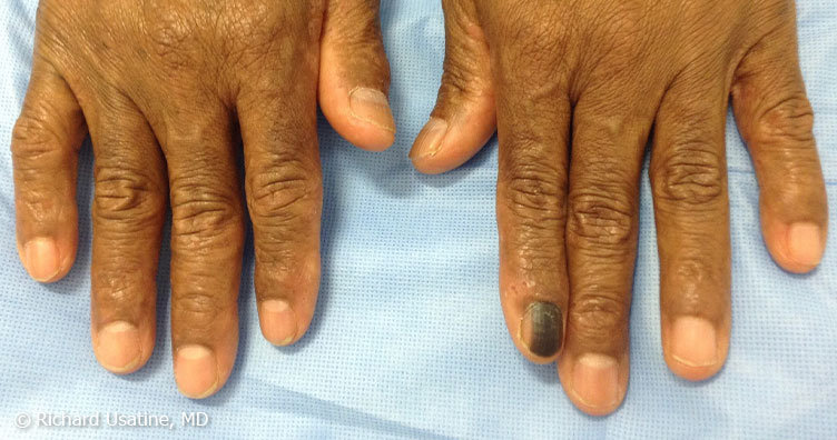 Subungual melanoma on fingernail