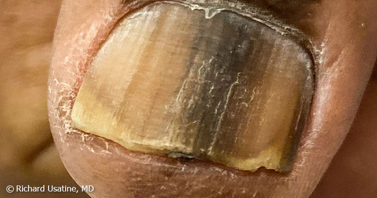 Subungual melanoma under toenail
