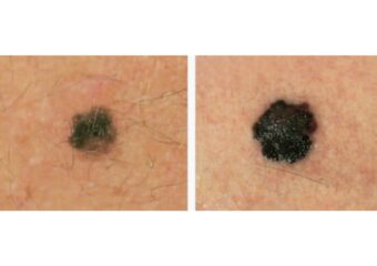 evolving melanoma
