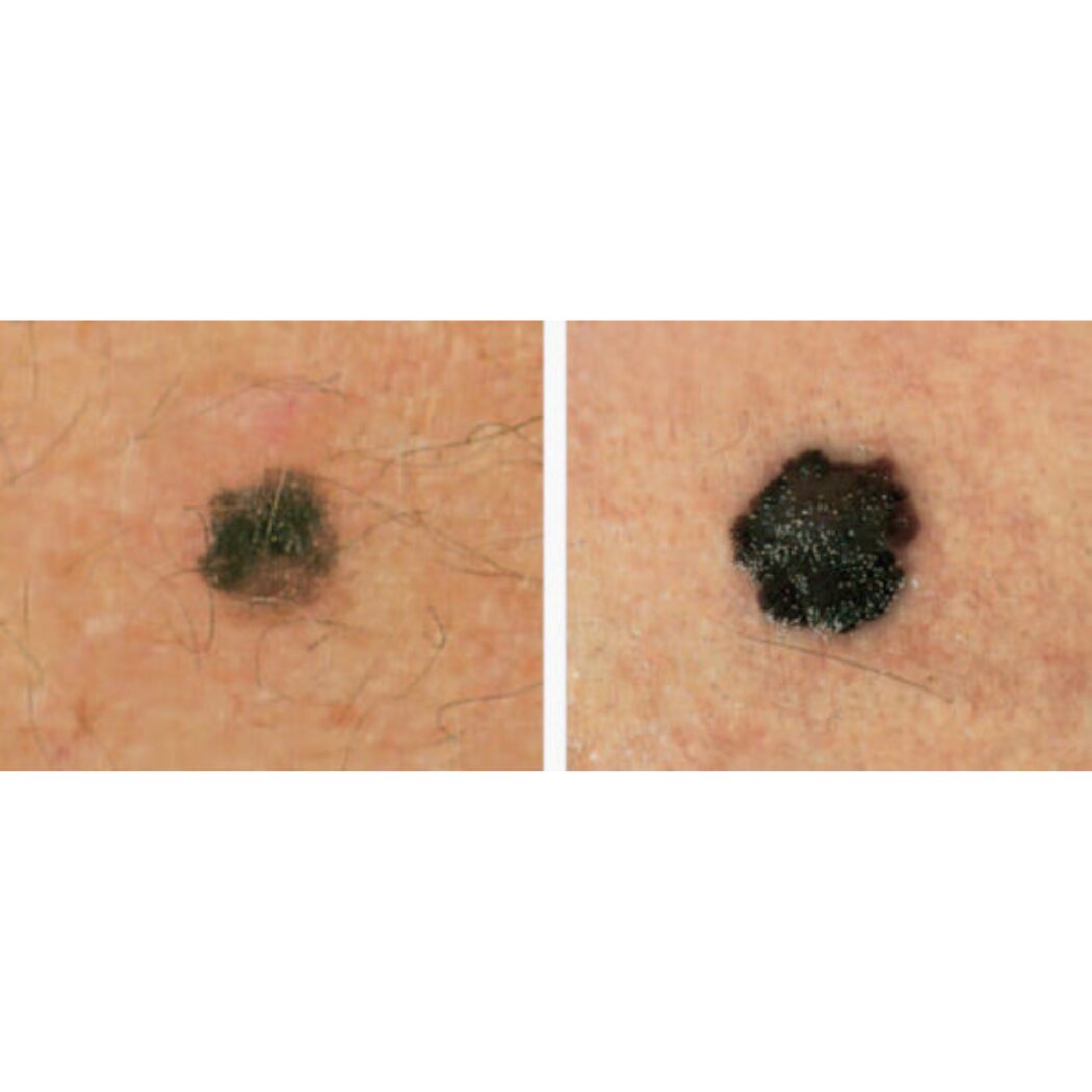 evolving-melanoma-journal